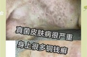 狗皮肤病后的适宜洗澡时间（探讨狗皮肤病治愈后合适的洗澡时机）